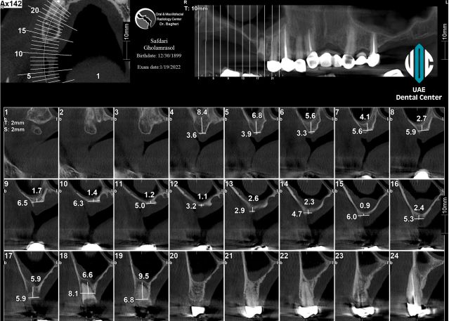 3D Bone Grafting Surgery in Tehran ( IRAN )