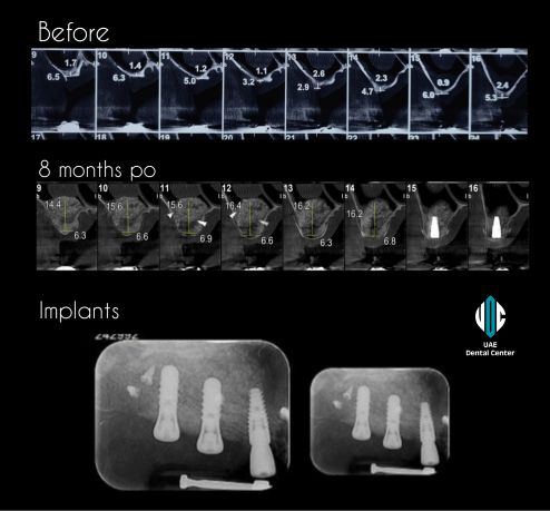 3D Bone Grafting Surgery in Tehran ( IRAN )