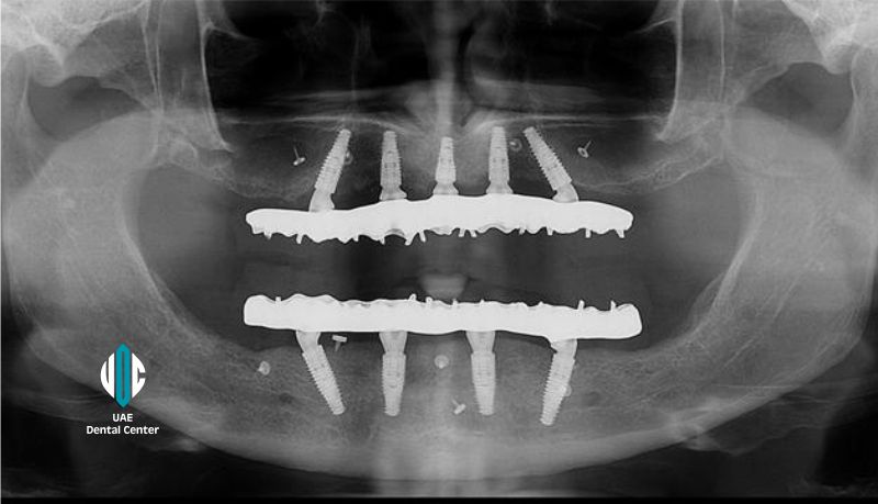 All on 4 Implants in Tehran ( IRAN )