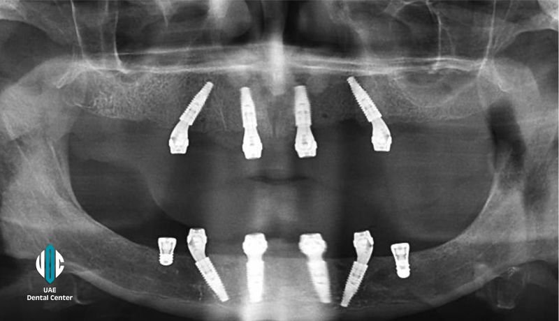 Digital All on 6 Implants in Tehran ( IRAN )