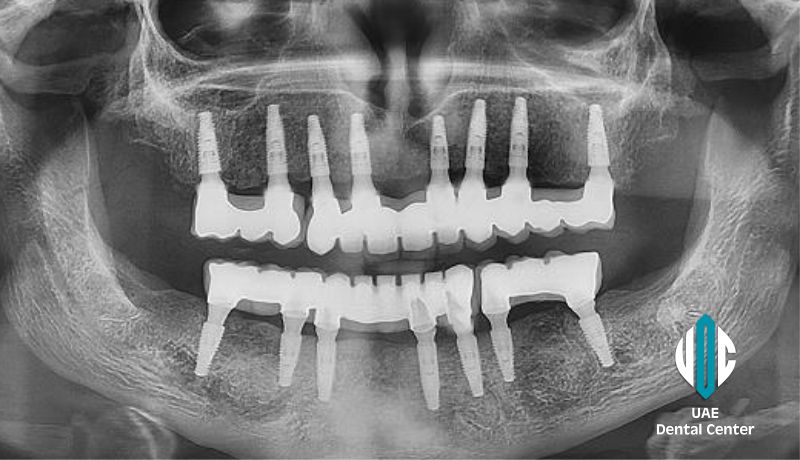 Full Mouth Rehabilitation in Tehran ( IRAN )