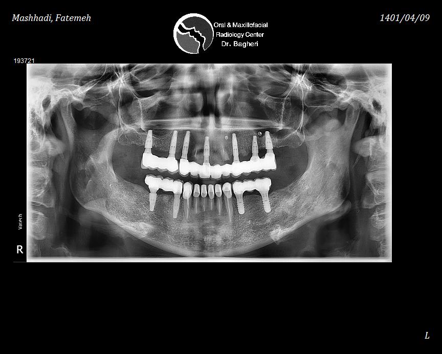 Full Mouth Rehabilitation in Tehran ( IRAN )