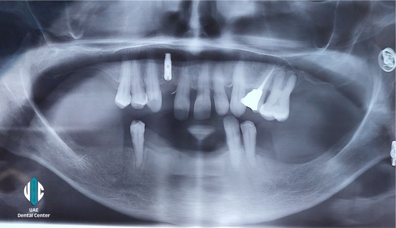 Same Day All on 6 Implants in Tehran ( IRAN )