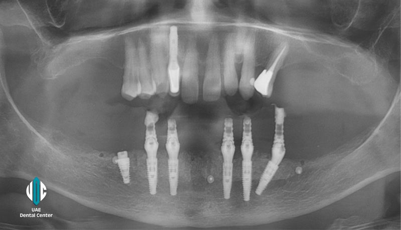 Same Day All on 6 Implants in Tehran ( IRAN )