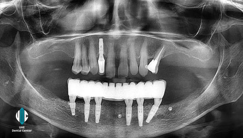 Same Day All on 6 Implants in Tehran ( IRAN )