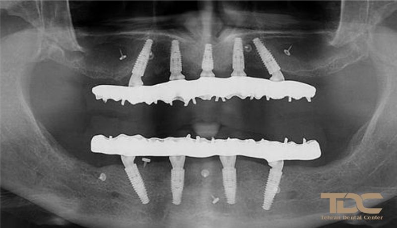 بهترین ایمپلنت All on 4 تهران