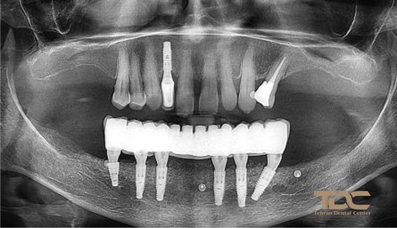 بهترین ایمپلنت All on 6 تهران