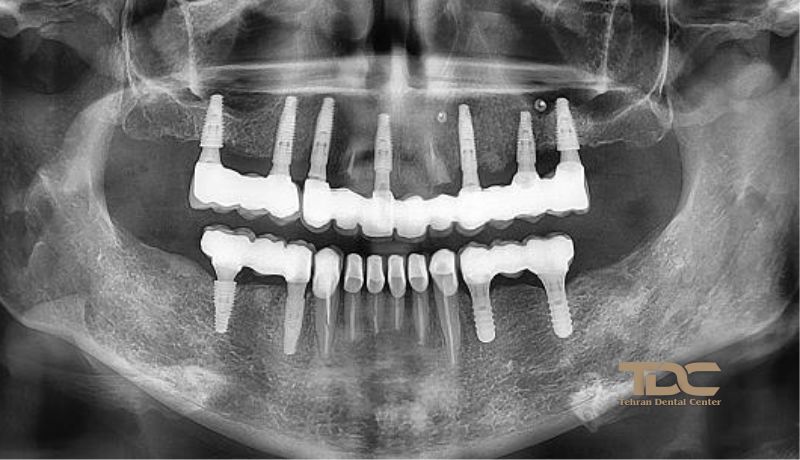 بهترین ایمپلنت کامل فک تهران