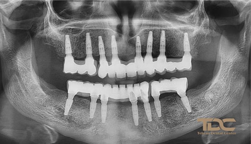 بهترین ایمپلنت کامل فک تهران