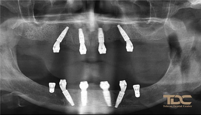 Best Immediate implant in tehran